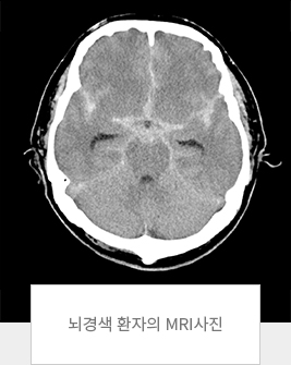 뇌경색 환자의 mri사진