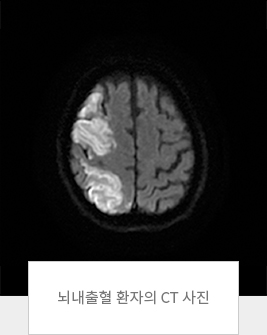 뇌내출혈 환자의 CT 사진