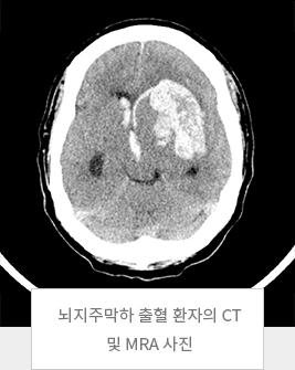 뇌지주막하 출혈 환자의 CT 및 MRA 사진