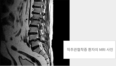 척추관협착증 환자의 MRI 사진