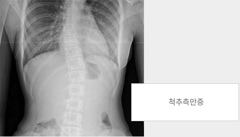 척추측만증