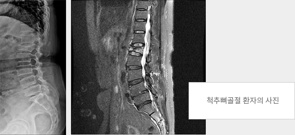 척추뼈골절 환자의 사진