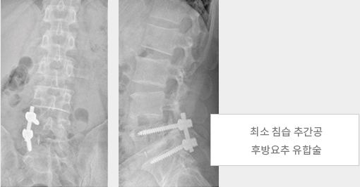 최소 침습 추간공 / 후방요추 유합술