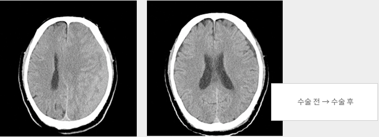 두개골천두술 : 수술 전 → 수술 후
