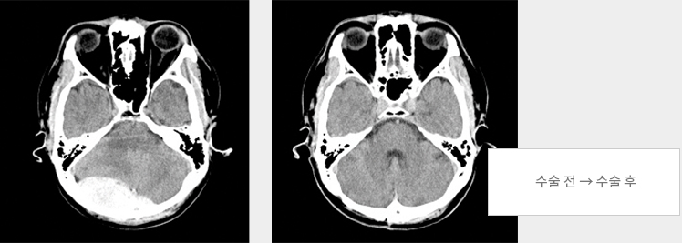 개두술 : 수술 전 → 수술 후