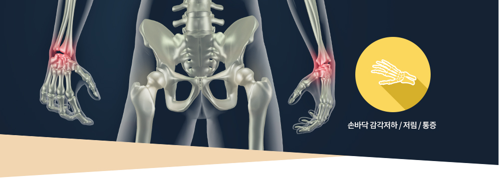 수근관 증후군 : 손바닥 감각저하 / 저림 / 통증 