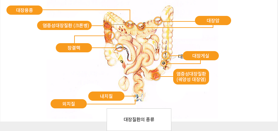 대장질환의 종류