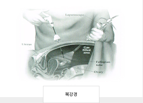 복강경