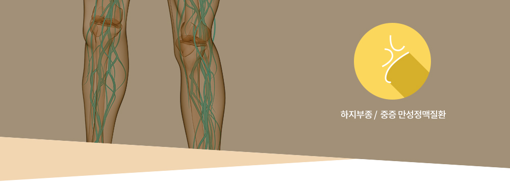 하지정맥류 :하지부종 /  중증 만성정맥질환