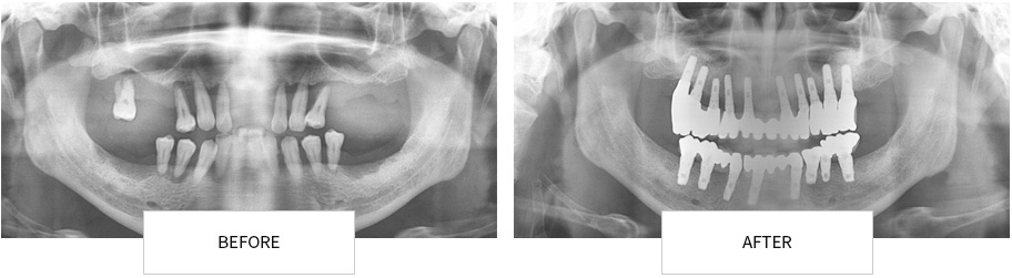 전악 임플란트 BEFORE / AFTER