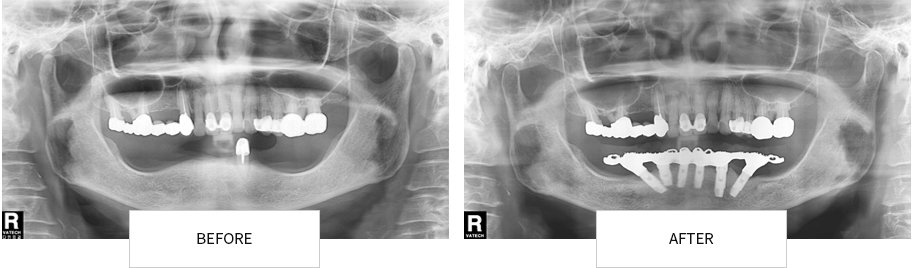 하이브리드 덴처 임플란트 BEFORE / AFTER
