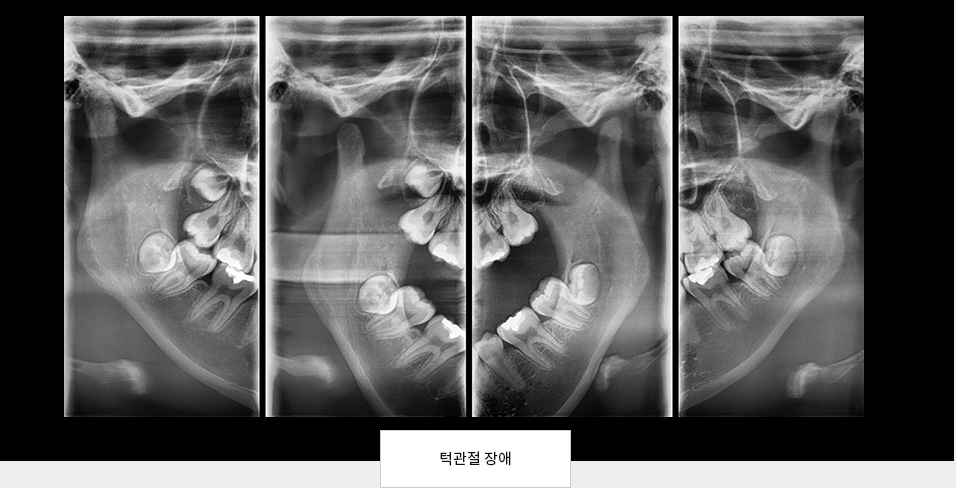 턱관절 장애